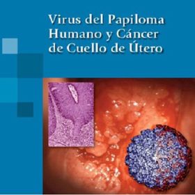 Virus del Papiloma Humano y Cáncer de Cuello de Útero