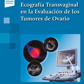 Alcàzar – Ecografìa transvaginal en la evaluaciòn de los tumores de ovarios