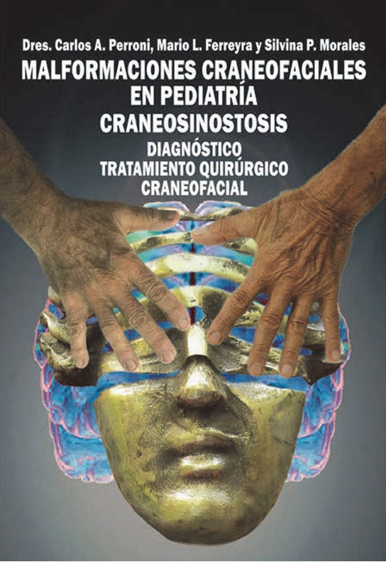 Malformaciones craneofaciales en pediatría – Perroni