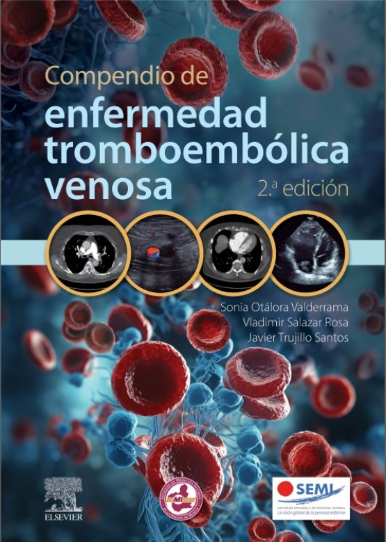 Compendio de enfermedad tromboembólica venosa – Otalora